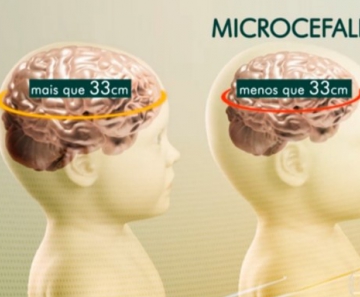 Cérebro de criança com microcefalia tem menos de 33 centímetros 